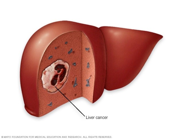 liver cancer